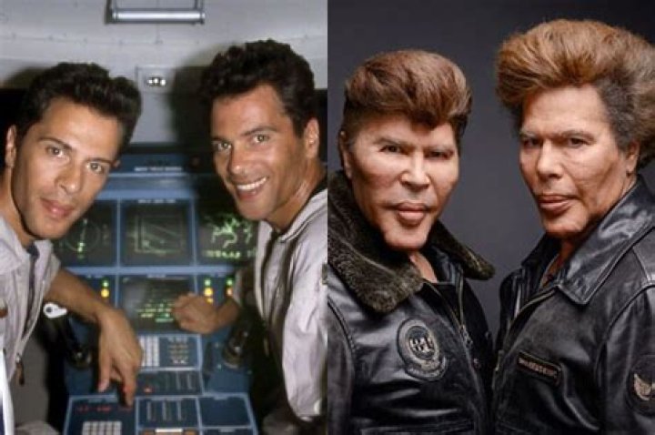 Bogdanoff Twins Before And After Surgery Photos What Did Bogdanoff