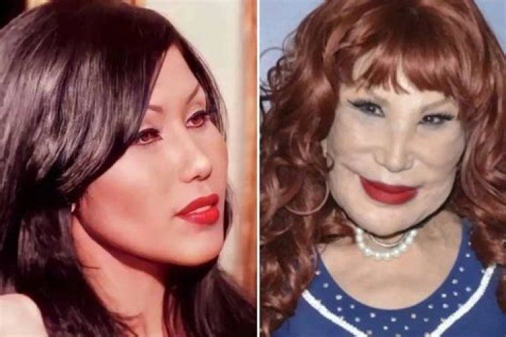 Lyn May Plastic Surgery Let’s Reveal All about It!