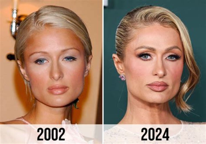 Paris Hilton Plastic Surgery Myths Microcurrent is What's Hot NewBeauty